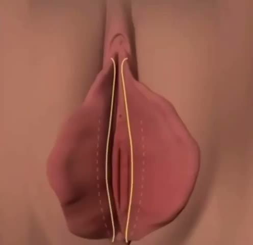 Ninfoplastia — visão geral