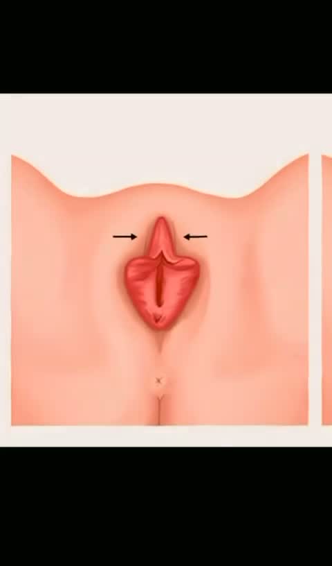 Sobre a ninfoplastia